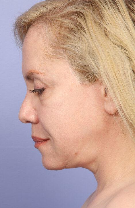 Laser Skin Resurfacing Gallery Before & After Image