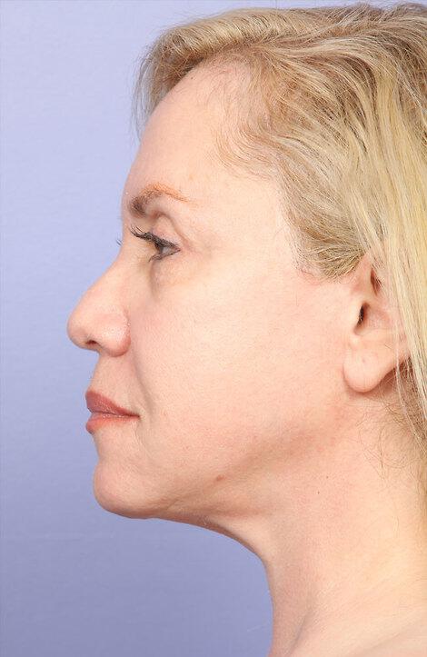 Laser Skin Resurfacing Gallery Before & After Image