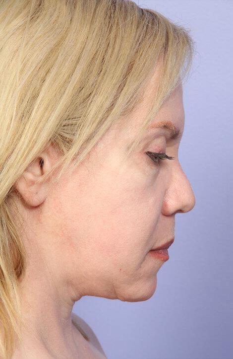 Laser Skin Resurfacing Gallery Before & After Image