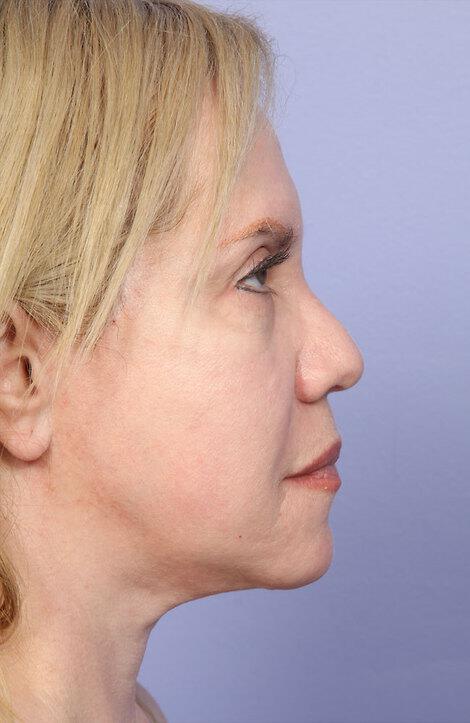 Laser Skin Resurfacing Gallery Before & After Image