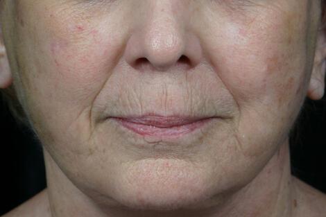 Laser Skin Resurfacing Gallery Before & After Image