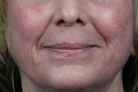 Laser Skin Resurfacing Gallery Before & After Image