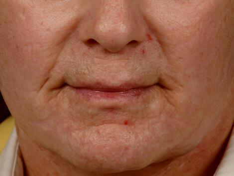 Laser Skin Resurfacing Gallery Before & After Image