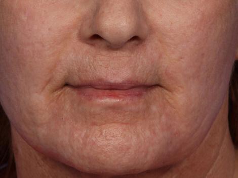 Laser Skin Resurfacing Gallery Before & After Image