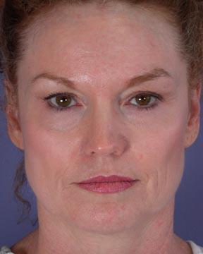 Laser Skin Resurfacing Gallery Before & After Image