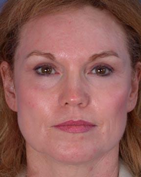 Laser Skin Resurfacing Gallery Before & After Image