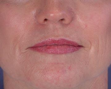 Laser Skin Resurfacing Gallery Before & After Image