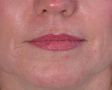 Laser Skin Resurfacing Gallery Before & After Image