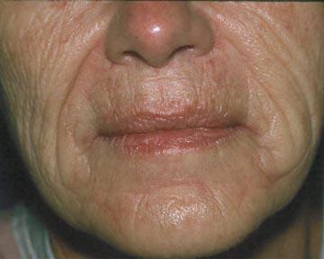 Laser Skin Resurfacing Gallery Before & After Image