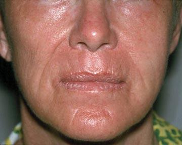 Laser Skin Resurfacing Gallery Before & After Image