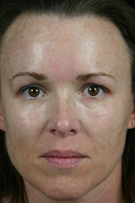 Laser Skin Resurfacing Gallery Before & After Image