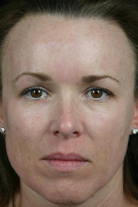 Laser Skin Resurfacing Gallery Before & After Image