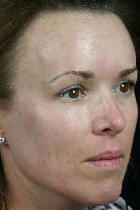 Laser Skin Resurfacing Gallery Before & After Image