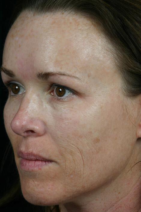 Laser Skin Resurfacing Gallery Before & After Image