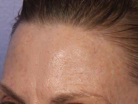 Laser Skin Resurfacing Gallery Before & After Image