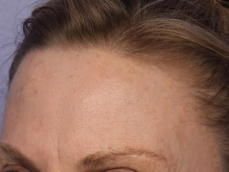 Laser Skin Resurfacing Gallery Before & After Image