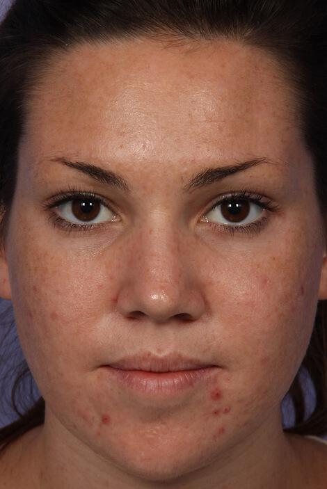 Laser Skin Resurfacing Gallery Before & After Image