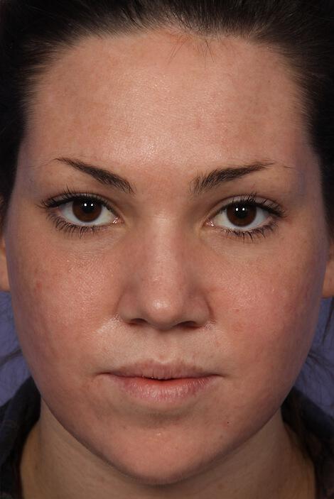 Laser Skin Resurfacing Gallery Before & After Image