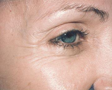 Laser Skin Resurfacing Gallery Before & After Image