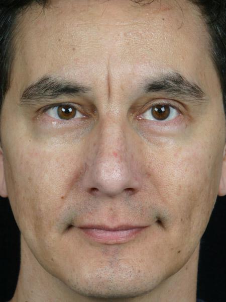 Laser Skin Resurfacing Gallery Before & After Image