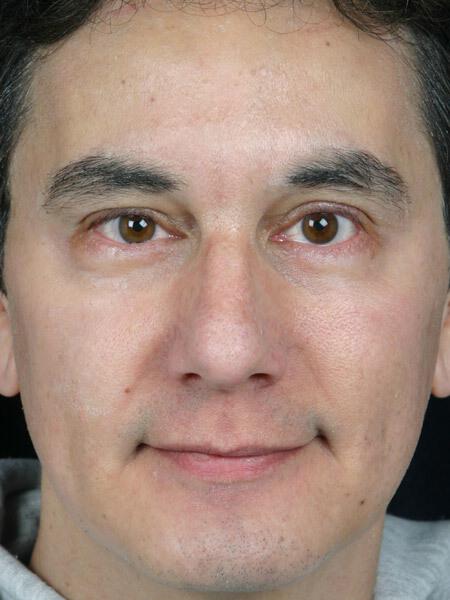 Laser Skin Resurfacing Gallery Before & After Image