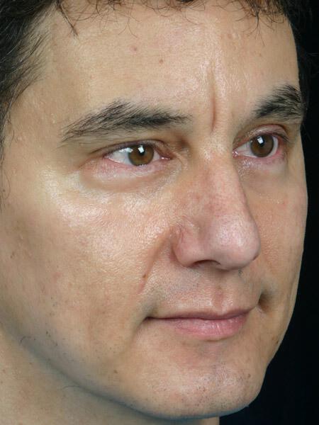 Laser Skin Resurfacing Gallery Before & After Image