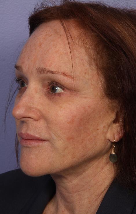 Laser Skin Resurfacing Gallery Before & After Image