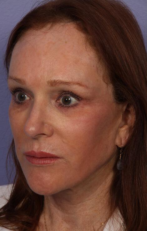 Laser Skin Resurfacing Gallery Before & After Image