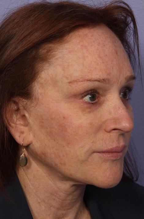 Laser Skin Resurfacing Gallery Before & After Image