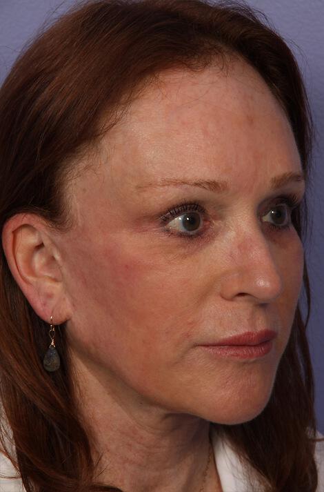 Laser Skin Resurfacing Gallery Before & After Image