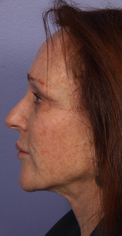 Laser Skin Resurfacing Gallery Before & After Image