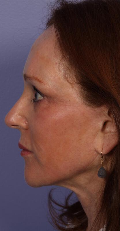 Laser Skin Resurfacing Gallery Before & After Image