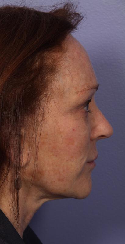 Laser Skin Resurfacing Gallery Before & After Image