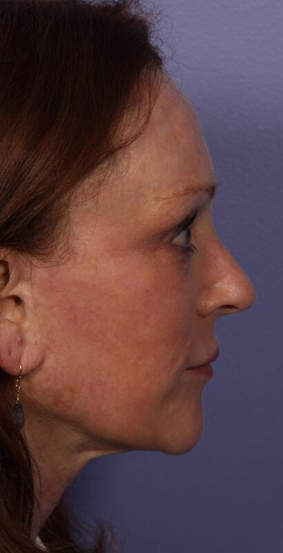 Laser Skin Resurfacing Gallery Before & After Image