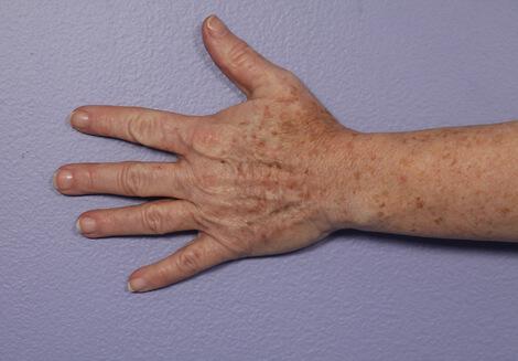 Laser Skin Resurfacing Gallery Before & After Image