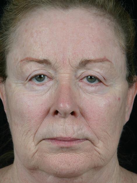 Laser Skin Resurfacing Gallery Before & After Image