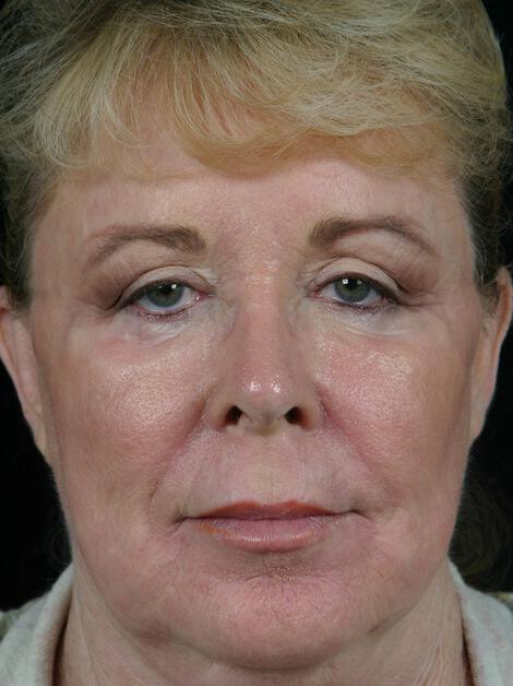 Laser Skin Resurfacing Gallery Before & After Image