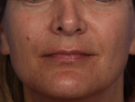 Laser Skin Resurfacing Gallery Before & After Image