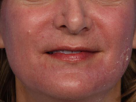 Laser Skin Resurfacing Gallery Before & After Image