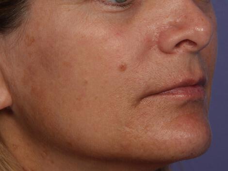 Laser Skin Resurfacing Gallery Before & After Image