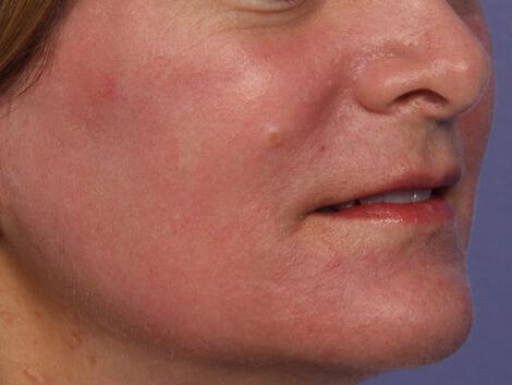 Laser Skin Resurfacing Gallery Before & After Image