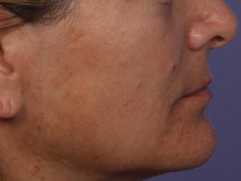 Laser Skin Resurfacing Gallery Before & After Image