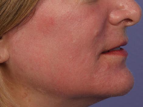 Laser Skin Resurfacing Gallery Before & After Image