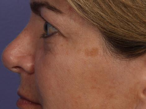 Laser Skin Resurfacing Gallery Before & After Image