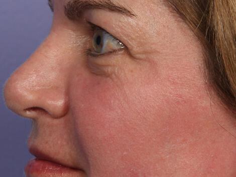 Laser Skin Resurfacing Gallery Before & After Image