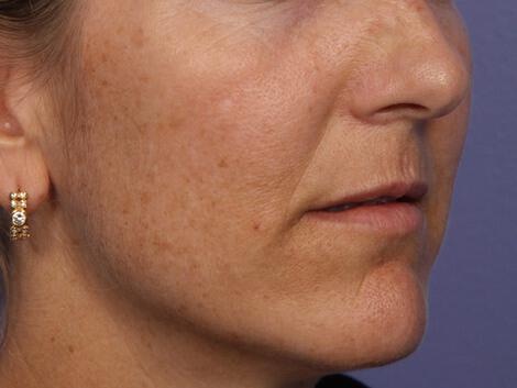 Laser Skin Resurfacing Gallery Before & After Image