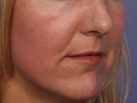 Laser Skin Resurfacing Gallery Before & After Image