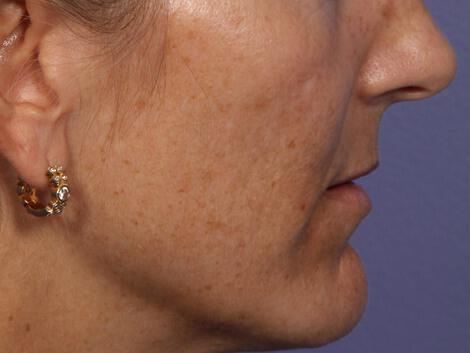 Laser Skin Resurfacing Gallery Before & After Image