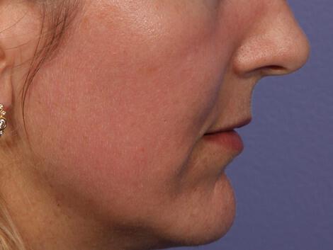 Laser Skin Resurfacing Gallery Before & After Image