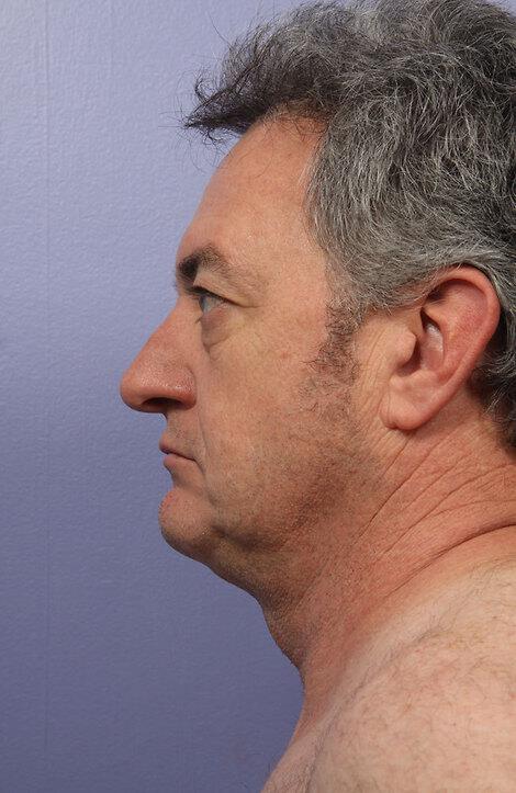 Laser Skin Resurfacing Gallery Before & After Image